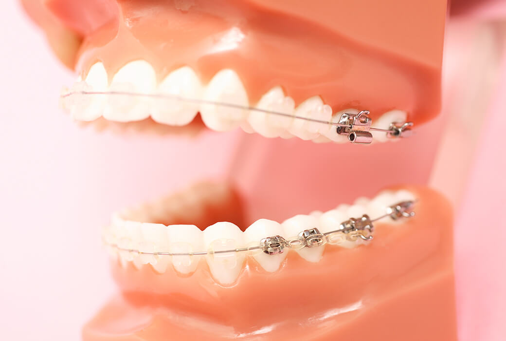 表側矯正（インシグニア）