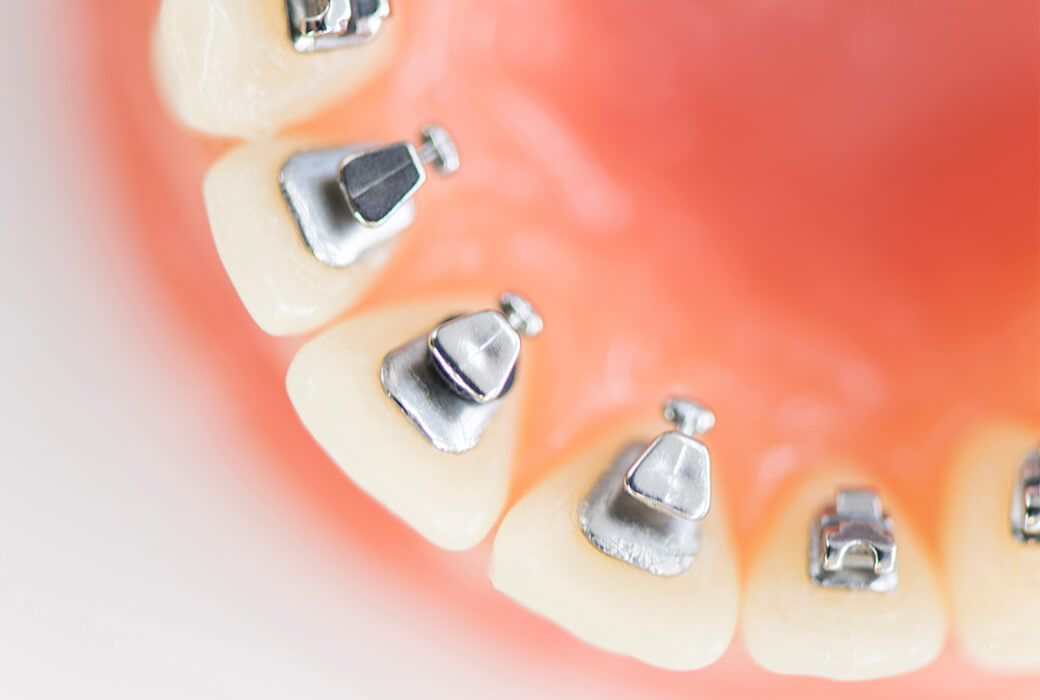 舌側矯正（裏側矯正）