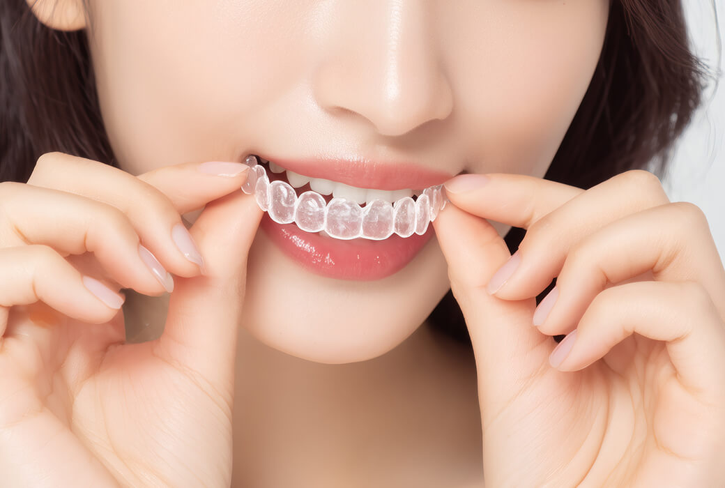 シュアスマイル（マウスピース矯正）