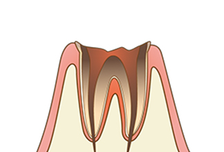 C4 歯質が失われた虫歯