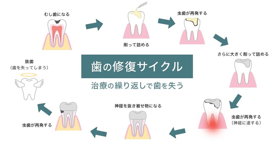 歯の治療は「繰り返すほど弱っていく」