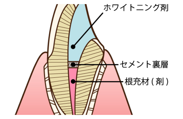 ウォーキングブリーチ