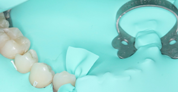 ラバーダム治療について