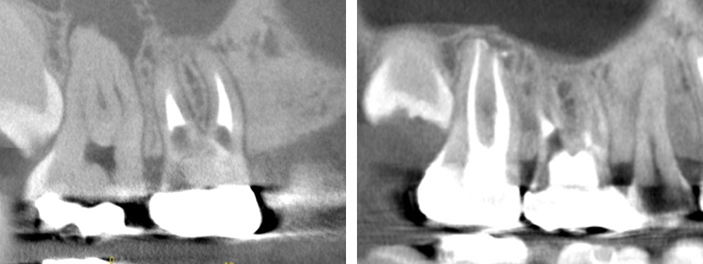 症例21：精密根管治療