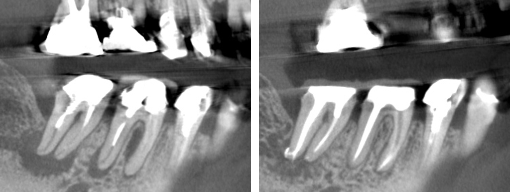 症例22：精密根管治療