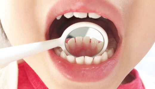 「子供の歯列矯正」について