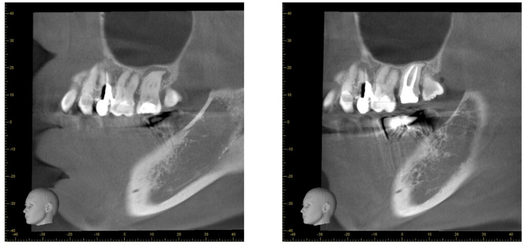 症例24：根尖性歯周炎