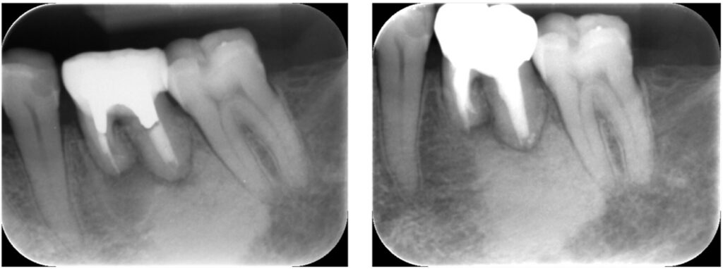 症例25：根尖性歯周炎
