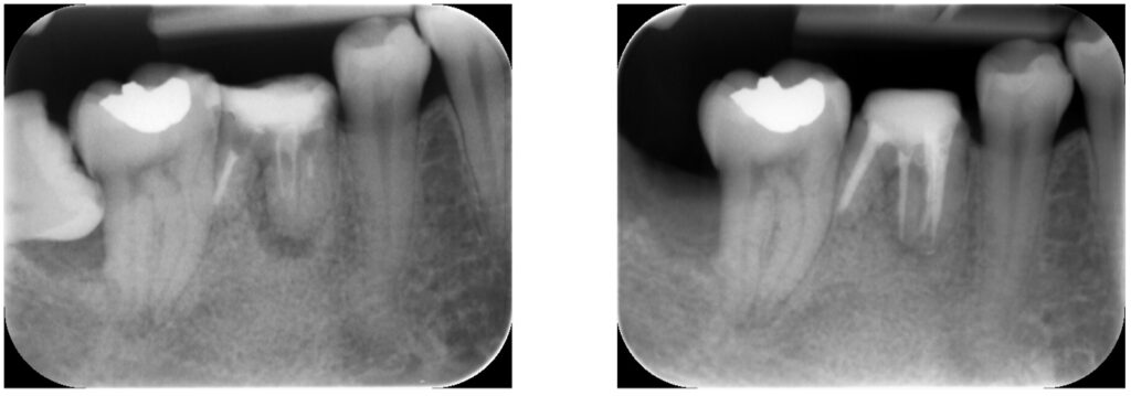 症例26：根尖性歯周炎