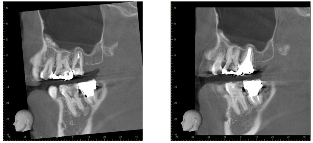 症例27：根尖性歯周炎