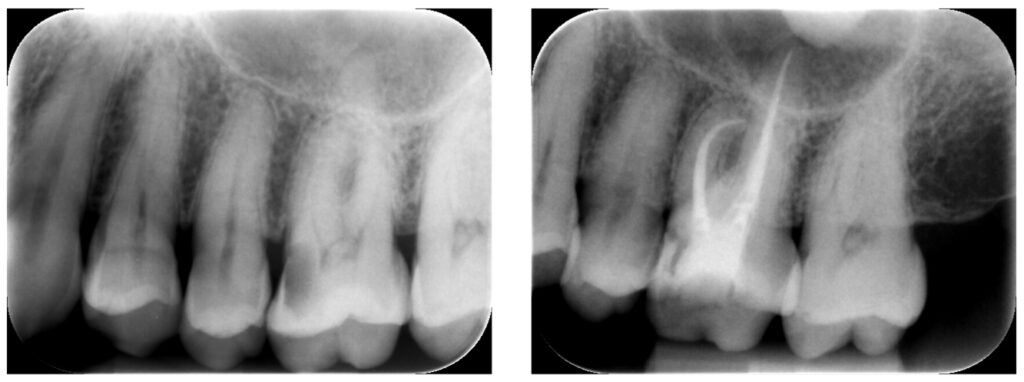 症例30：C3、症状無し歯髄炎