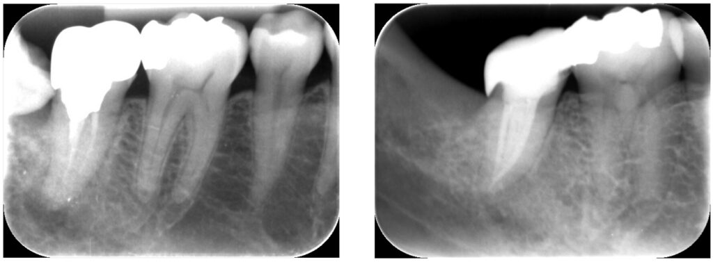 症例32：根尖性歯周炎