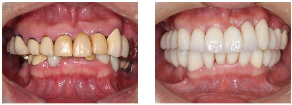 症例33：審美治療2