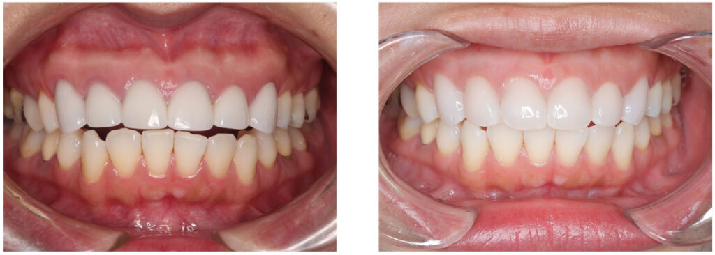 症例34：審美治療3