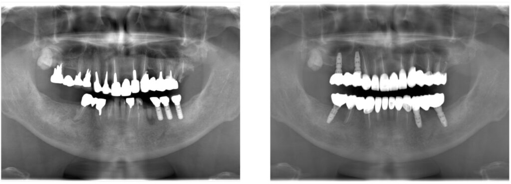 症例35：インプラント除去、インプラント治療