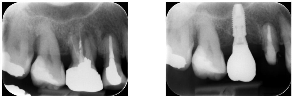 症例36：歯根破折した歯を抜歯して、インプラント治療