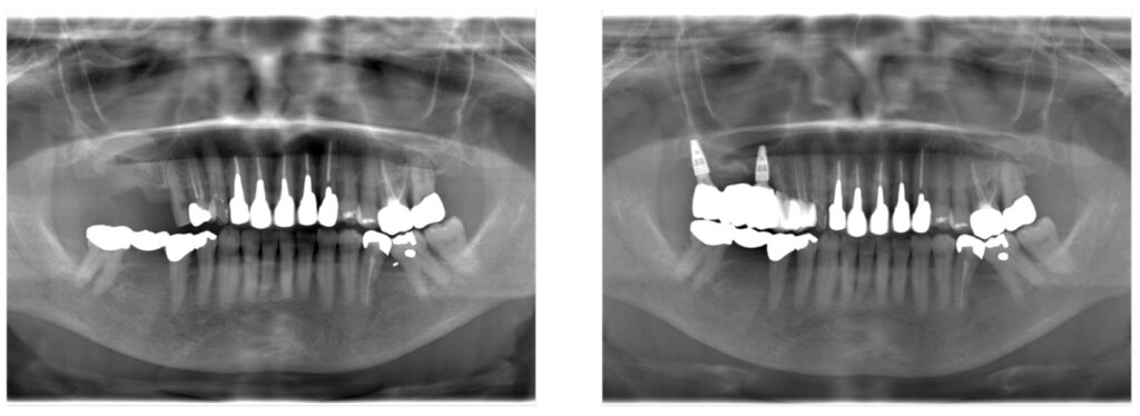 症例39：右上のインプラント治療