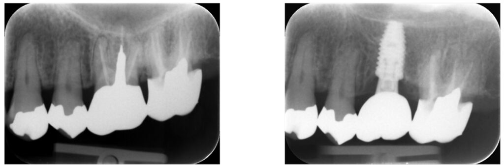 症例40：歯根破折している歯の抜歯とインプラント治療