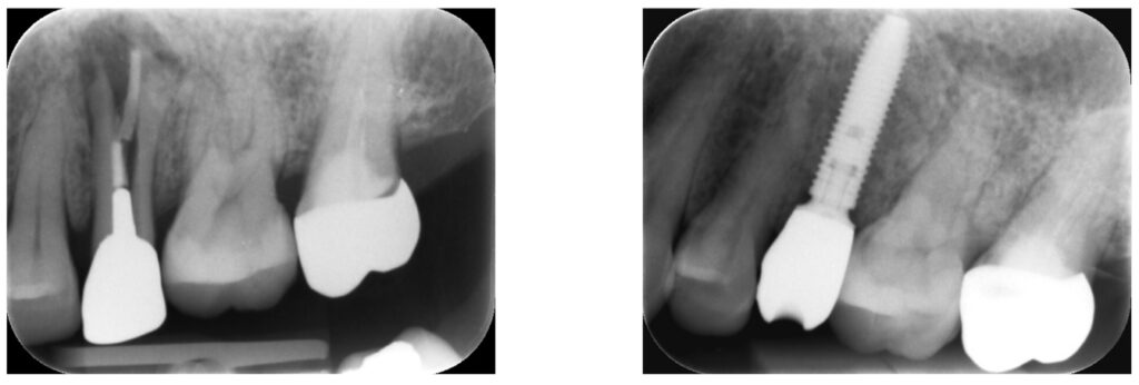 症例42：歯根破折した歯を抜歯し、インプラント治療