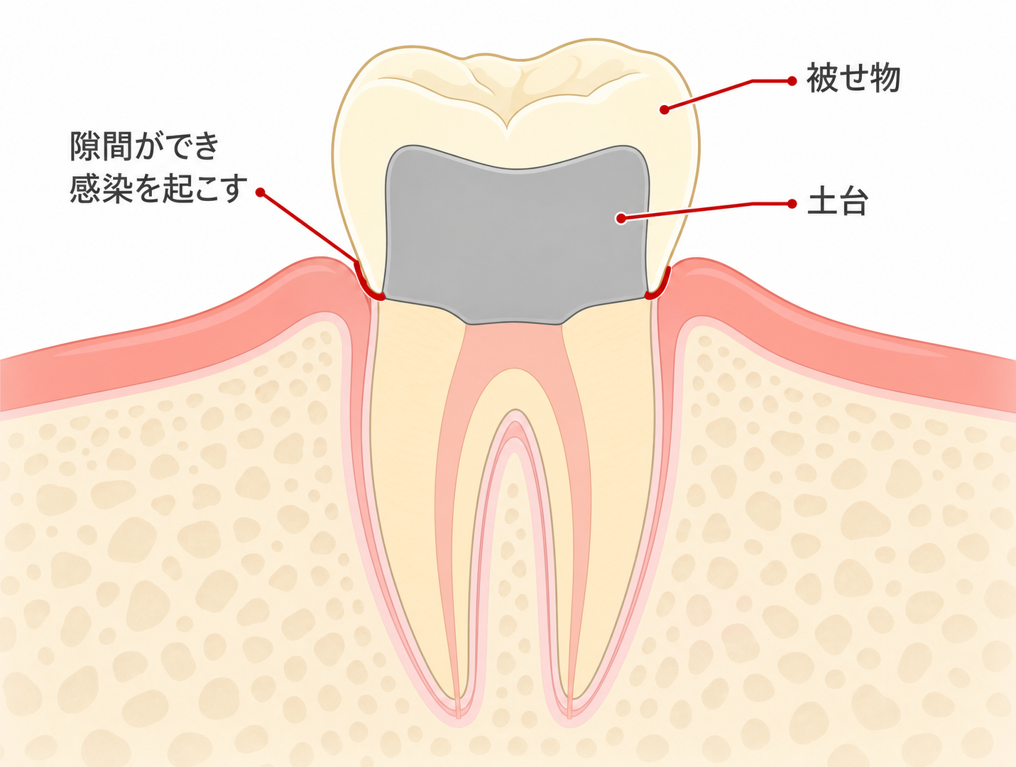 図解② コロナルリーケージのイメージ