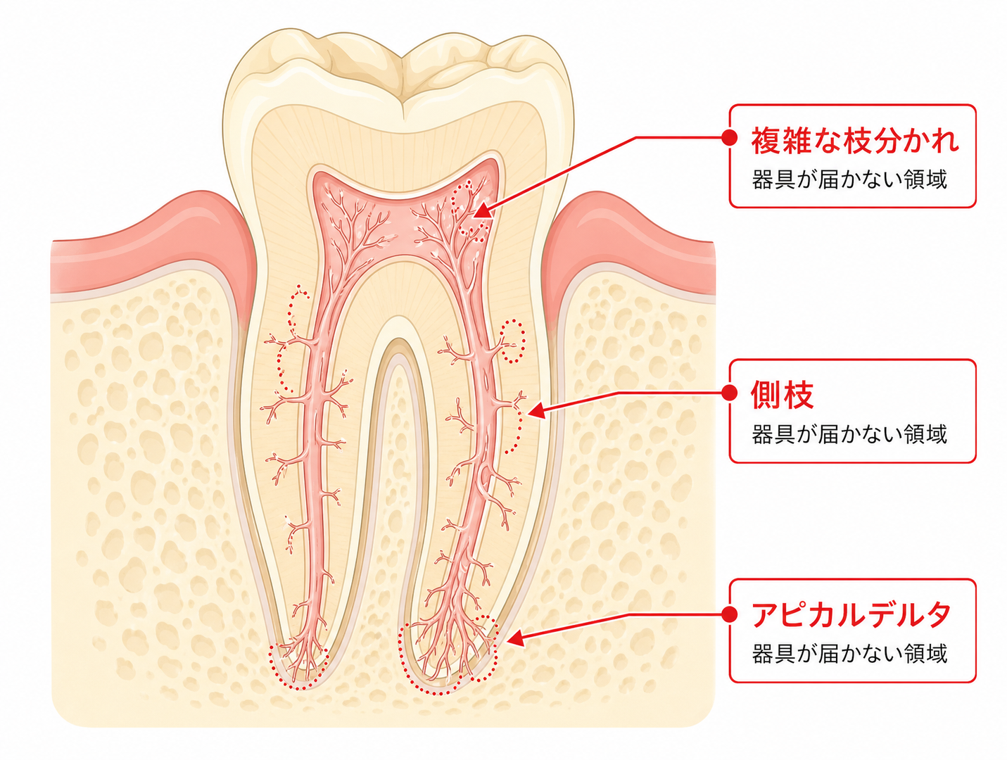 図解① 根管内部の複雑な解剖