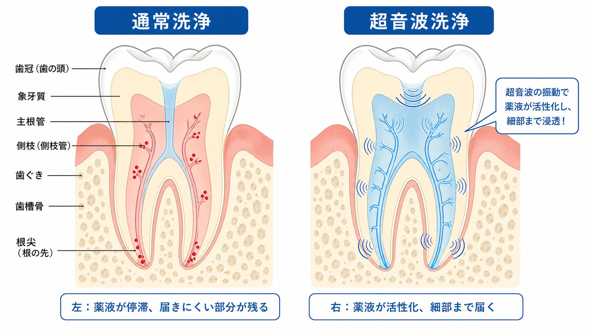 図解② 通常洗浄 vs 超音波洗浄