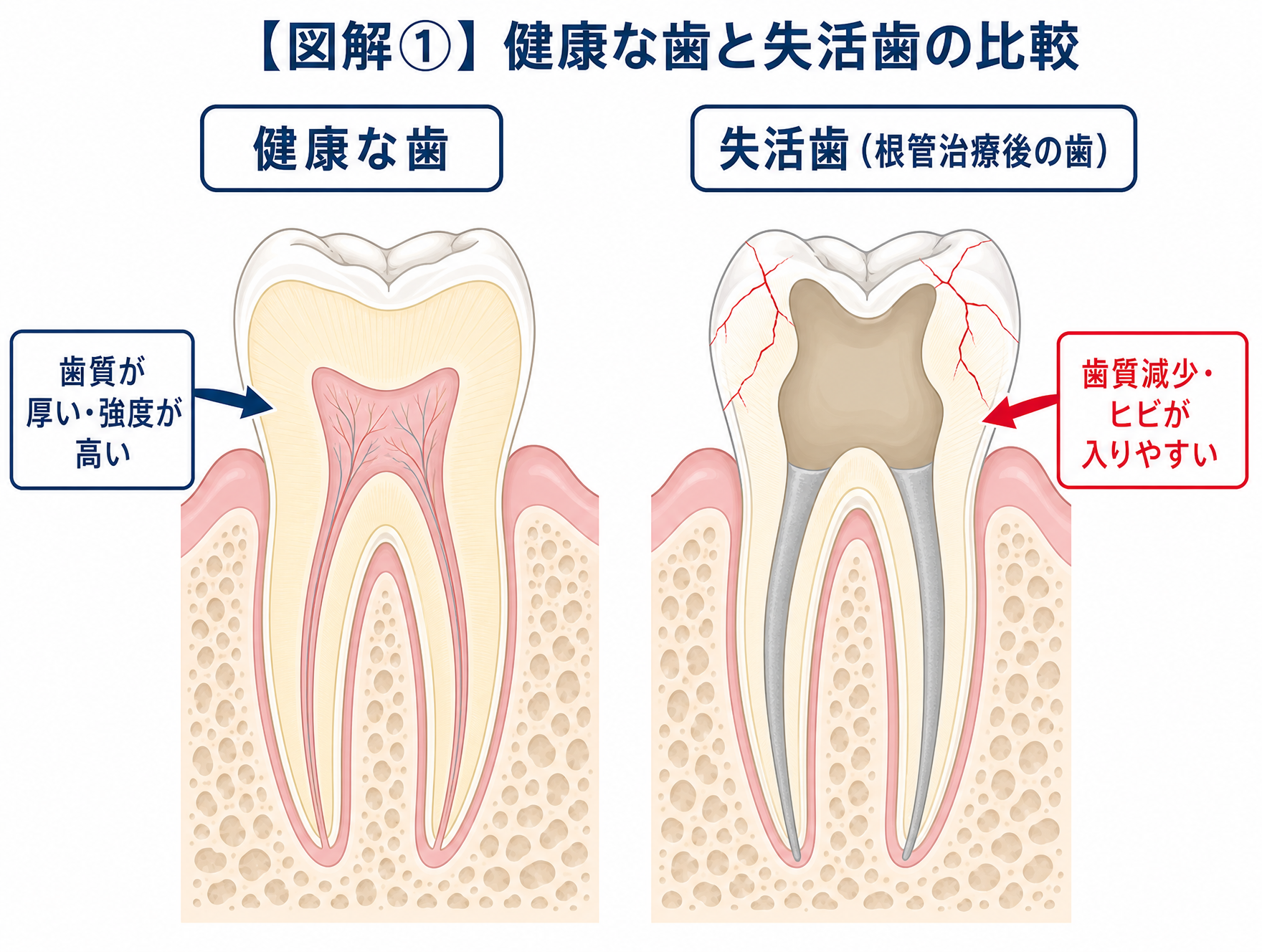 図解① 健康な歯と失活歯の比較