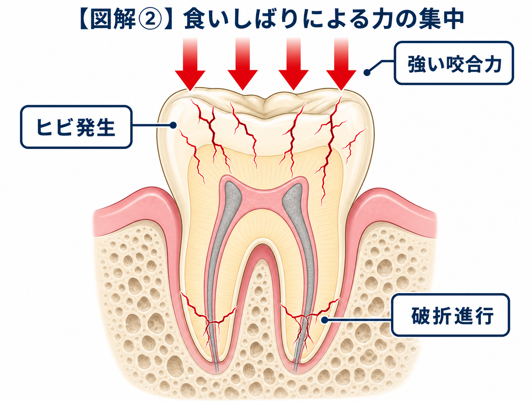 図解② 食いしばりによる力の集中