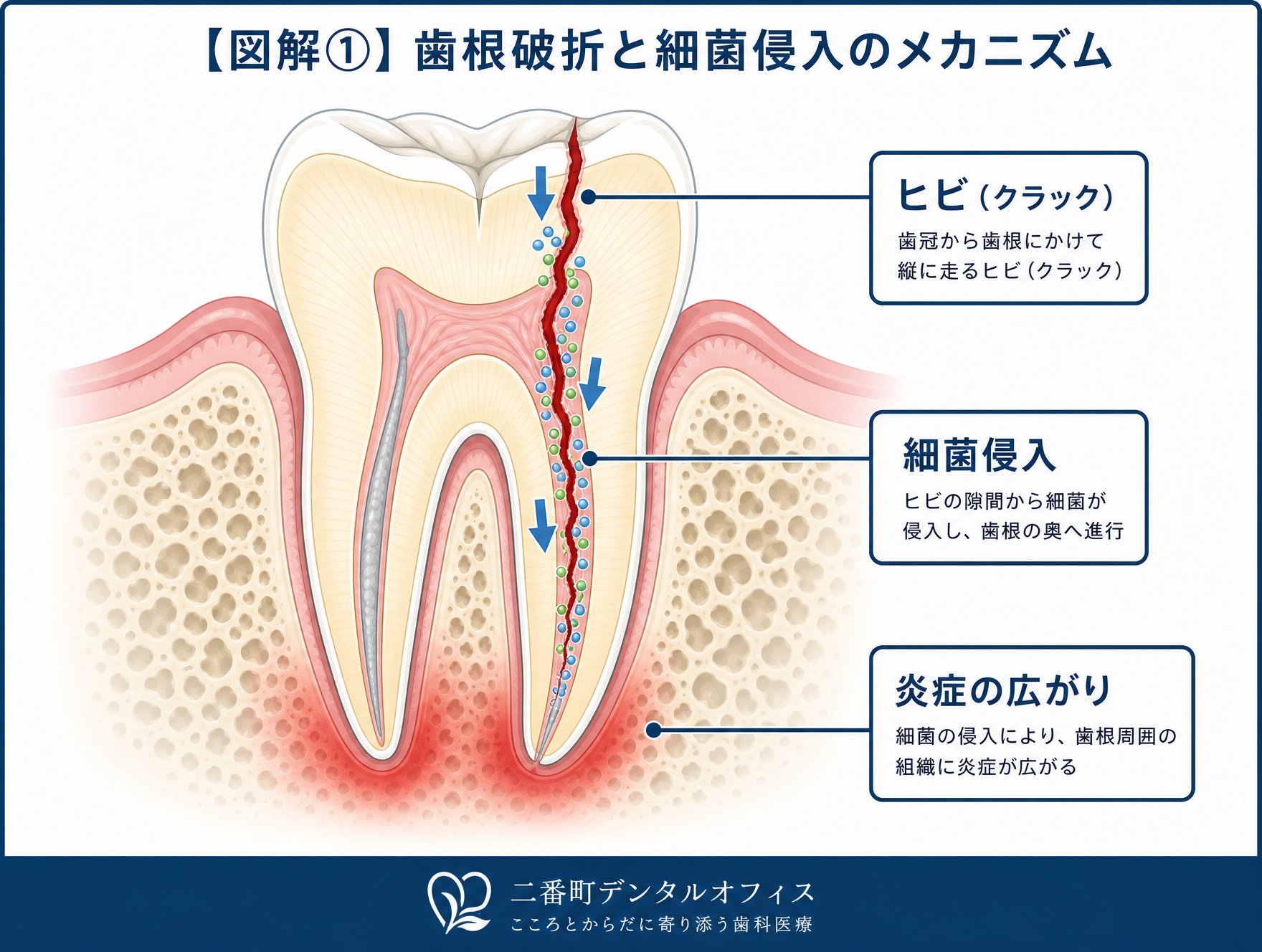 図解① 歯根破折と細菌侵入のメカニズム